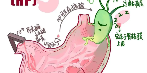 【必看】幽門(mén)螺桿菌真相揭示，別再忽視你的胃痛了！